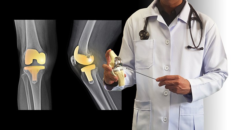 Total Joint Replacement: What You Should Know