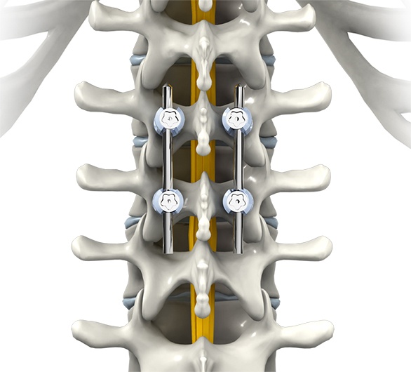 When is Spinal Fusion Surgery Recommended?