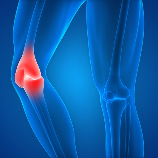 Patellar Tendinitis: Symptoms & Causes