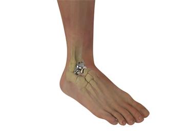 Total Ankle Replacement