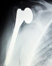Shoulder Replacement Surgery – What You Should Know