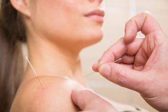 The Benefits of Acupuncture