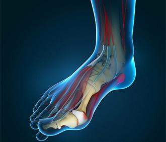 What To Do When You Have A Bunion