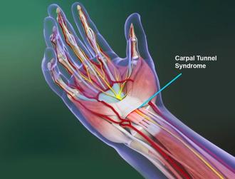 Understanding Carpal Tunnel Syndrome