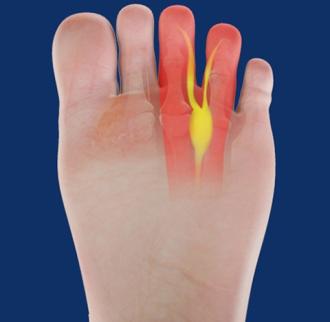 What Causes Morton’s Neuroma?