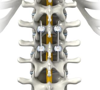 When is Spinal Fusion Surgery Recommended?