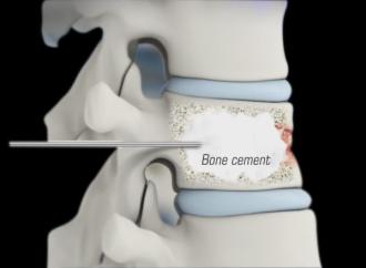 Stabilize Your Spine with Kyphoplasty