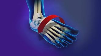 Chronic Lateral Ankle Instability Procedure at OCPBC