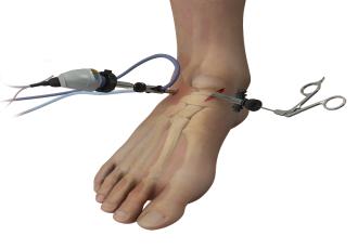 Common Conditions That Could Require Arthroscopic Ankle Surgery