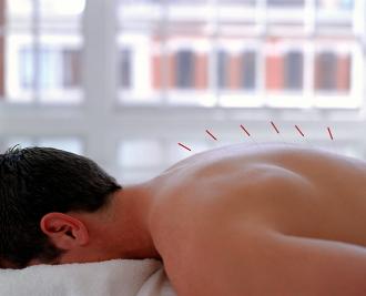 Frequently Asked Questions About Acupuncture Therapy